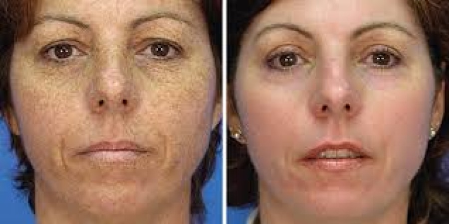 Carbon Peel (Hollywood Facial)